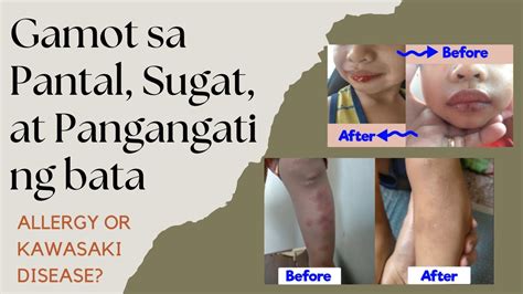 allergy sa sabon panlaba|6 paraan para mawala ang pangangati ng balat ng bata.